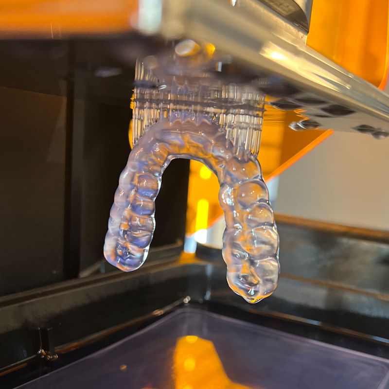 Plaque occlusale transparente fabriquée numériquement par impression 3D au laboratoire dentaire Digidental