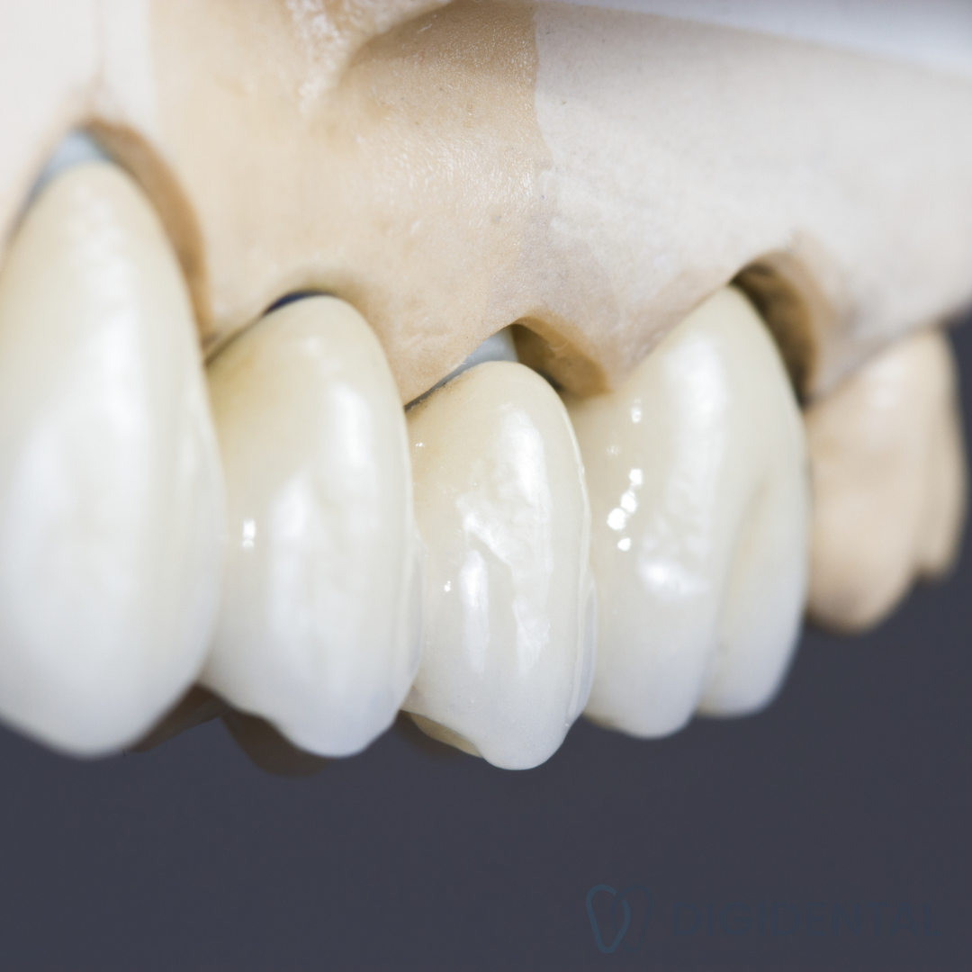Pont dentaire esthétique sur modèle de mâchoire fabriqué au laboratoire numérique Digidental à Laval