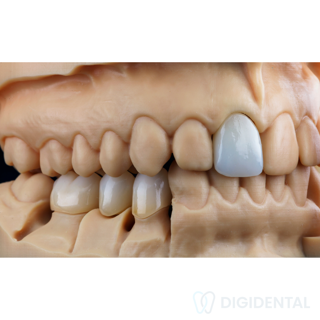 Couronne dentaire en zircone sur modèle 3D fabriquée au laboratoire numérique Digidental à Laval